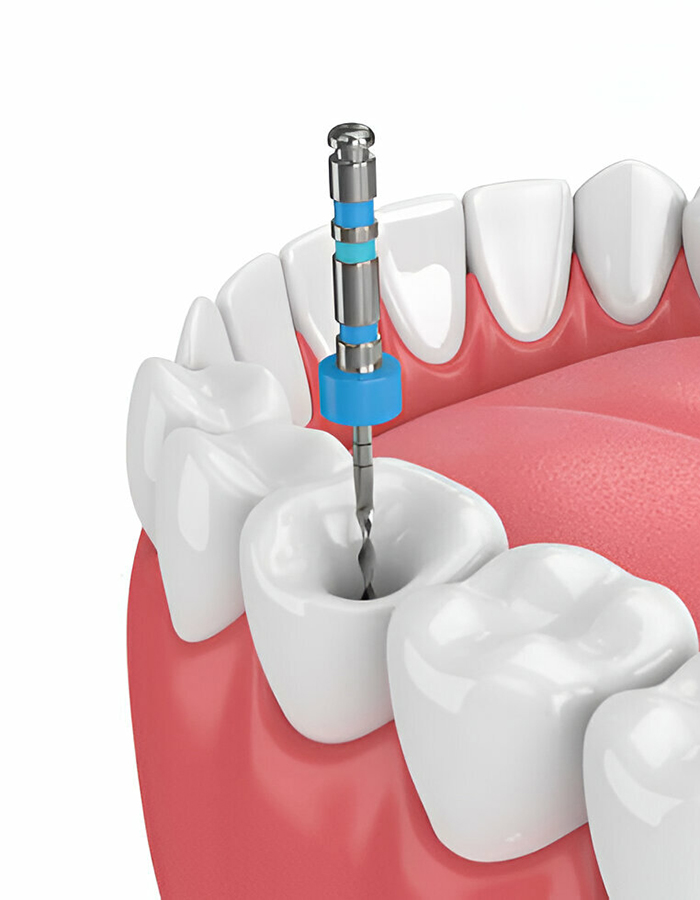 Implantología dental en Bahía Blanca - Consultorio odontológico privado