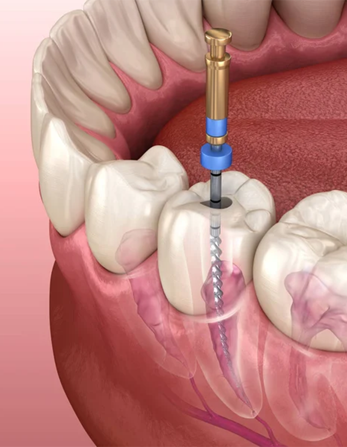 Implantología, Rehabilitación dental, Limpieza dental, Operatoria dental, Endodoncia mecanizada, Ortopedia y ortodoncia, Estética dental en Bahía Blanca - Consultorio odontológico privado