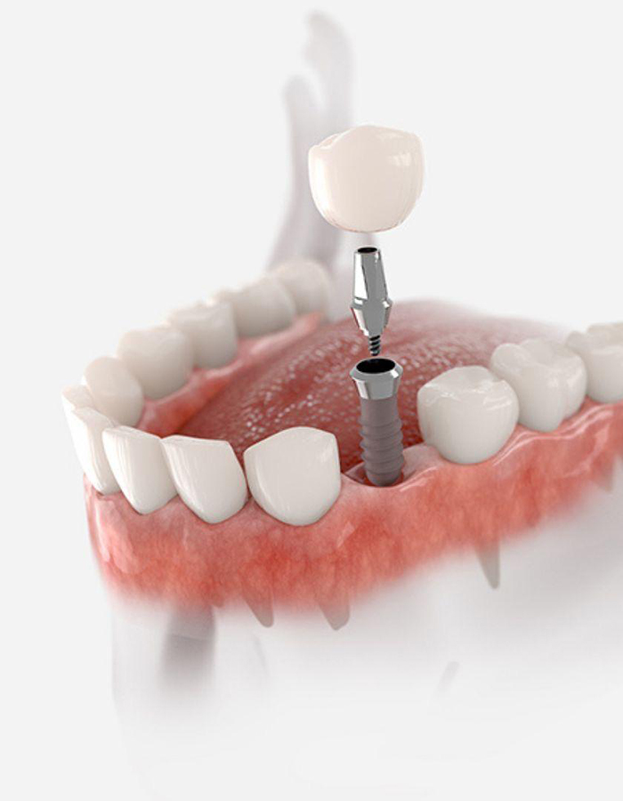 Implantología, Rehabilitación dental, Limpieza dental, Operatoria dental, Endodoncia mecanizada, Ortopedia y ortodoncia, Estética dental en Bahía Blanca - Consultorio odontológico privado
