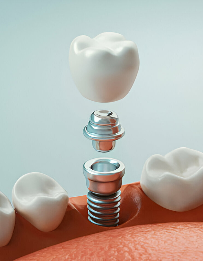Implantología, Rehabilitación dental, Limpieza dental, Operatoria dental, Endodoncia mecanizada, Ortopedia y ortodoncia, Estética dental en Bahía Blanca - Consultorio odontológico privado