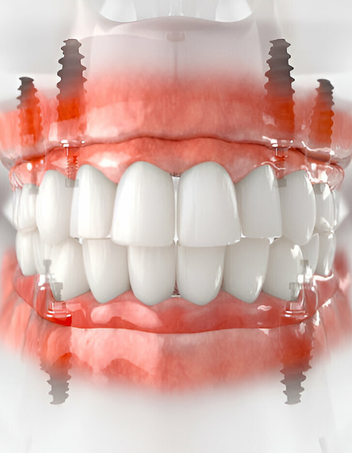 Implantología, Rehabilitación dental, Limpieza dental, Operatoria dental, Endodoncia mecanizada, Ortopedia y ortodoncia, Estética dental en Bahía Blanca - Consultorio odontológico privado